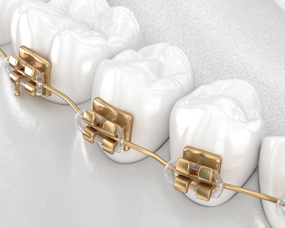 Gold champagne bracket braces to straighten teeth.